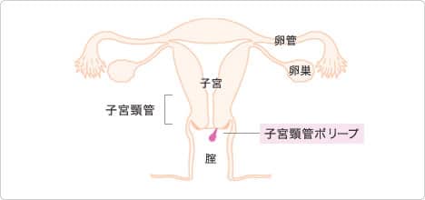 子宮頸管ポリープ