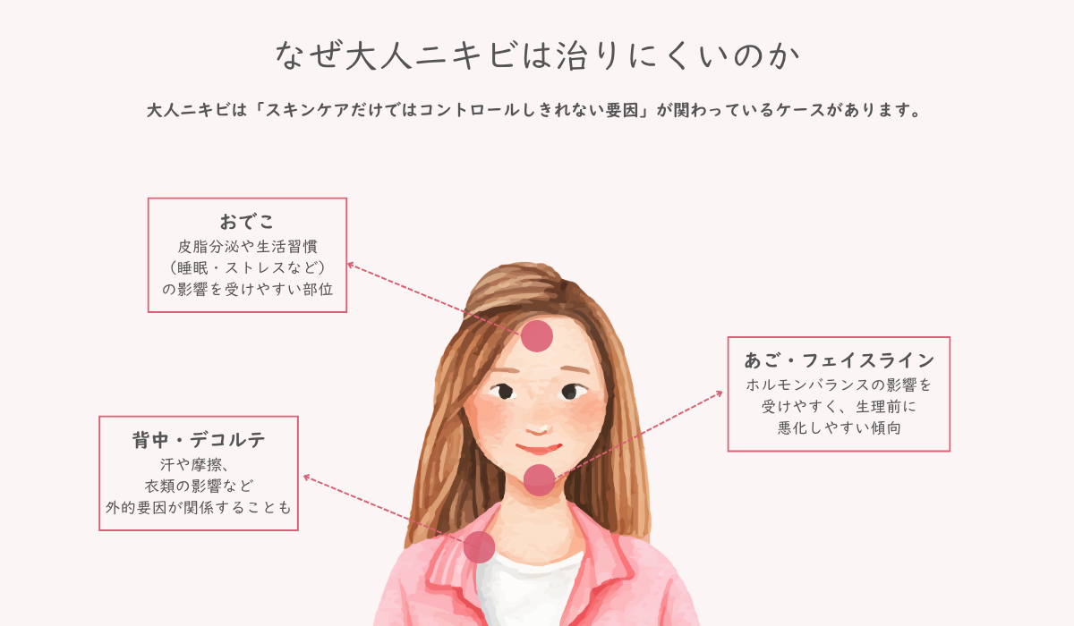 大人ニキビ①