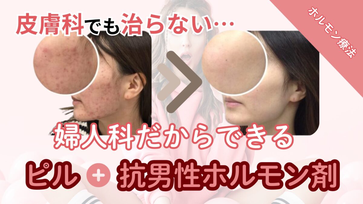 何をやっても治らない大人ニキビ…婦人科だからできる【ピル＋抗男性ホルモン剤】なら治るかもしれません